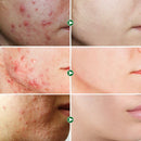 Akne elleni bőrkrém